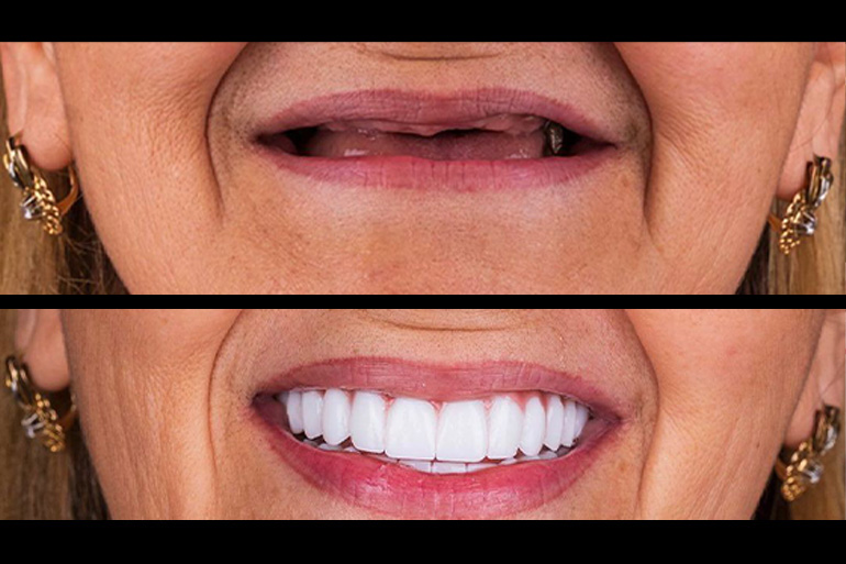 Türkiye'de All-on-4 Tedavisi Fiyatları