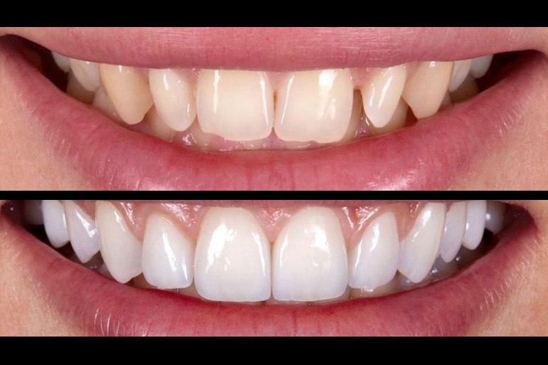 Türkiye’de Diş Kaplamaları Tedavisi