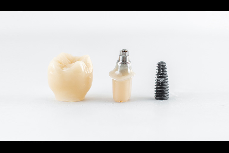 Türkiye’de Dental Implant Tedavisi