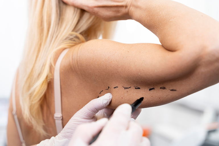 Türkiye'de Liposuction