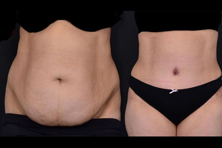 Türkiye'de Abdominoplasti (Tummy Tuck) Estetiği